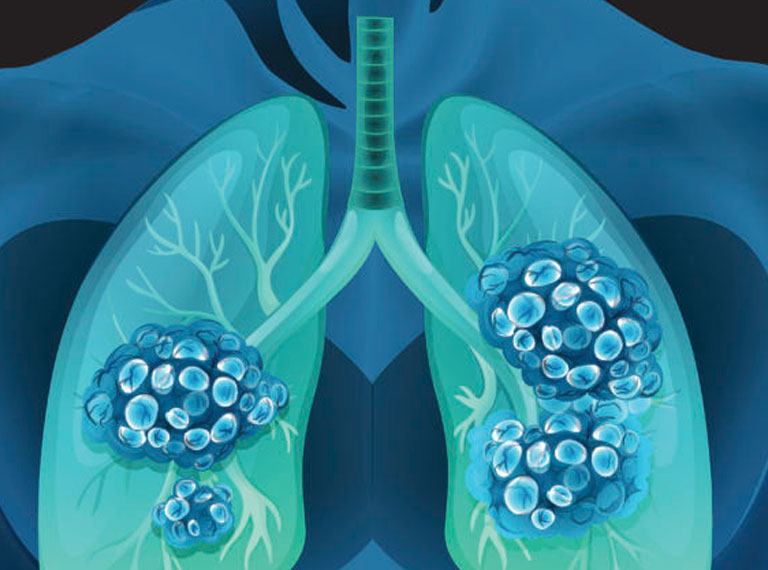 what causes nodules in the lungs